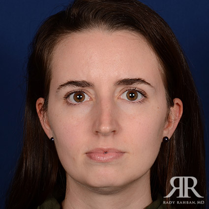 Female Rhinoplasty