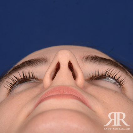 Female Rhinoplasty