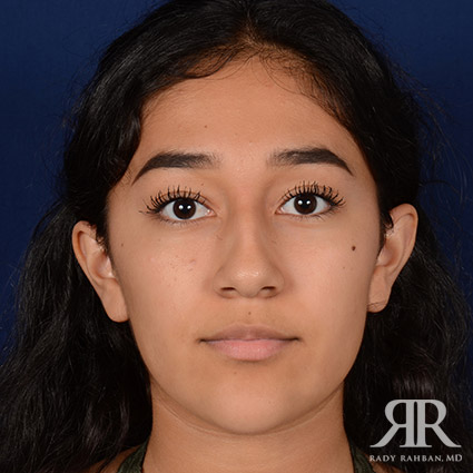 Female Rhinoplasty