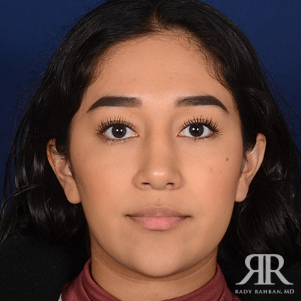 Female Rhinoplasty