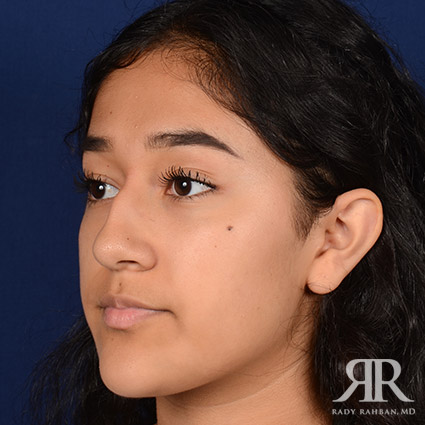 Female Rhinoplasty