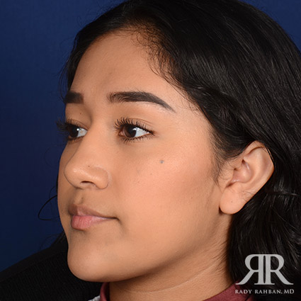 Female Rhinoplasty