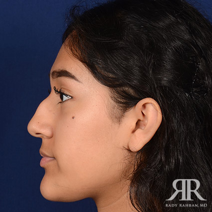 Female Rhinoplasty