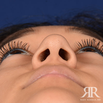 Female Rhinoplasty