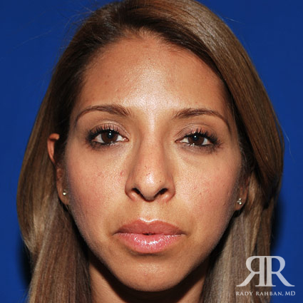 Female Rhinoplasty