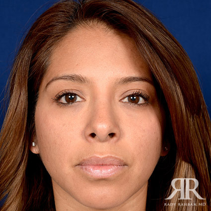 Female Rhinoplasty