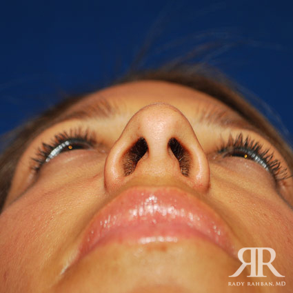 Female Rhinoplasty