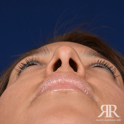 Female Rhinoplasty