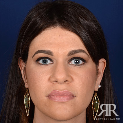Female Rhinoplasty