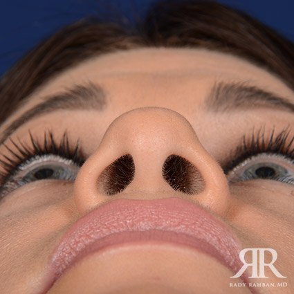 Female Rhinoplasty