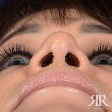 Female Rhinoplasty