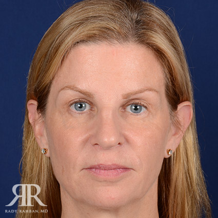 Female Rhinoplasty