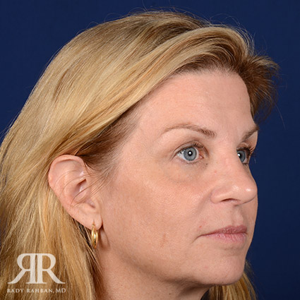 Female Rhinoplasty