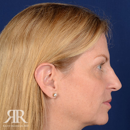 Female Rhinoplasty