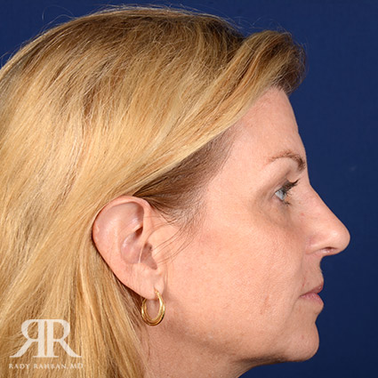 Female Rhinoplasty