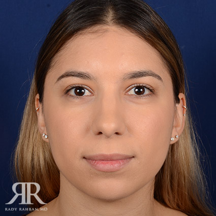 Female Rhinoplasty