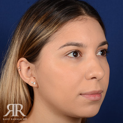 Female Rhinoplasty