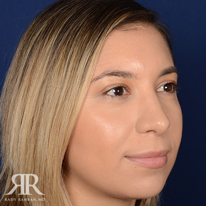 Female Rhinoplasty