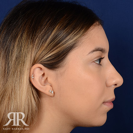 Female Rhinoplasty