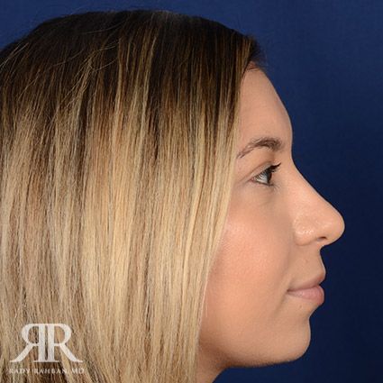 Female Rhinoplasty