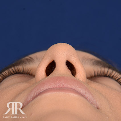 Female Rhinoplasty