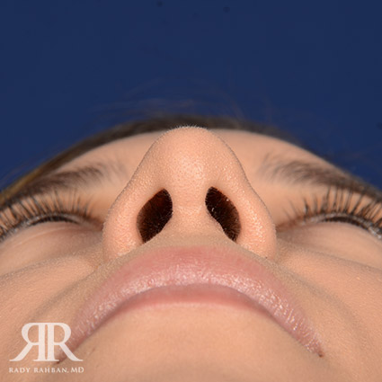 Female Rhinoplasty