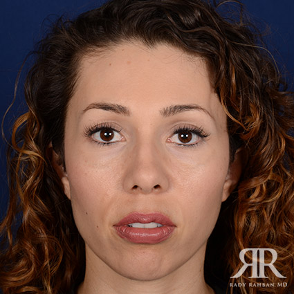 Female Rhinoplasty