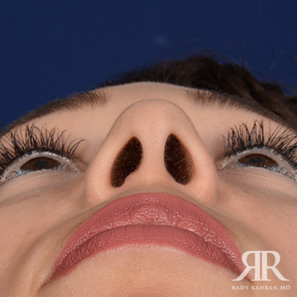 Female Rhinoplasty