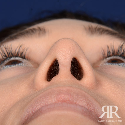 Female Rhinoplasty