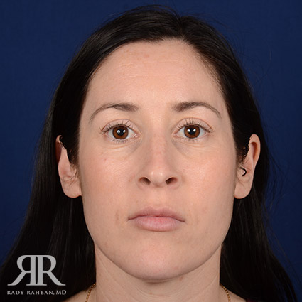 Female Rhinoplasty