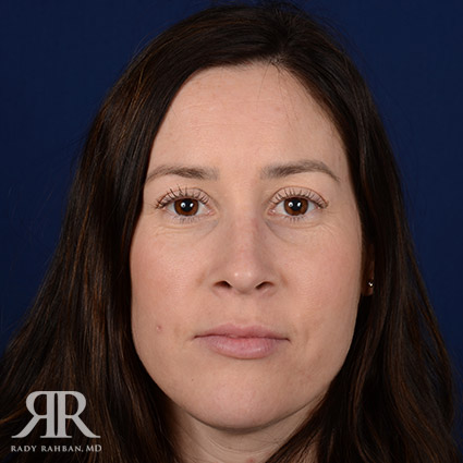 Female Rhinoplasty