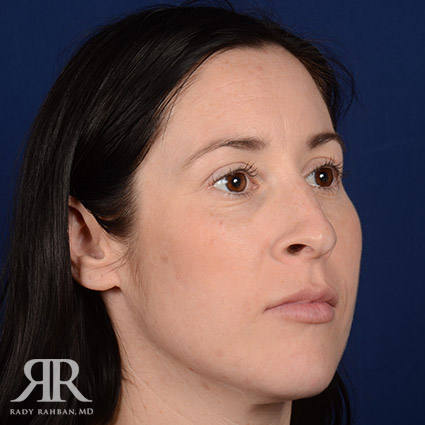 Female Rhinoplasty