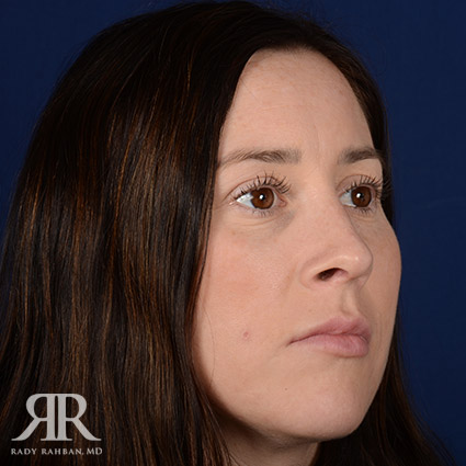 Female Rhinoplasty