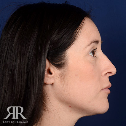 Female Rhinoplasty