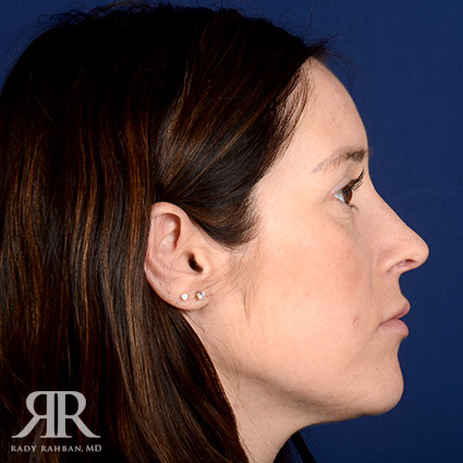 Female Rhinoplasty