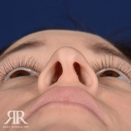 Female Rhinoplasty