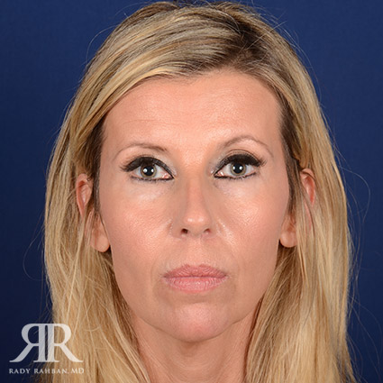 Female Rhinoplasty