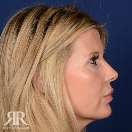 Female Rhinoplasty