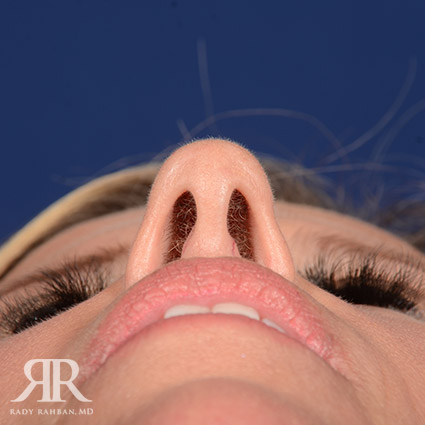 Female Rhinoplasty