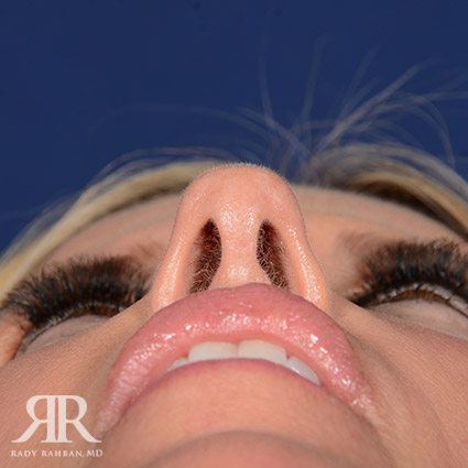 Female Rhinoplasty