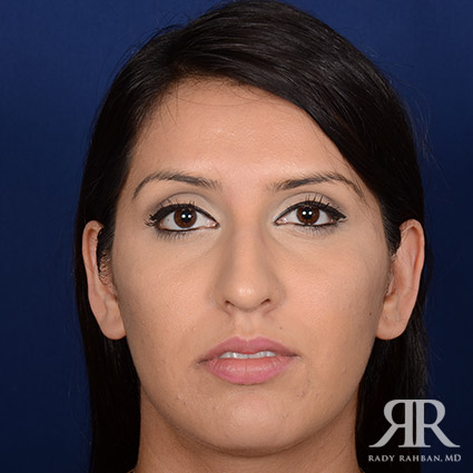 Female Rhinoplasty