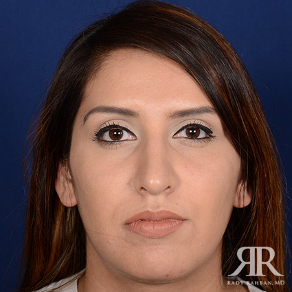 Female Rhinoplasty