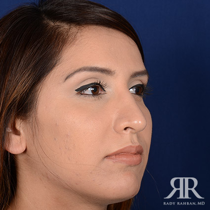 Female Rhinoplasty