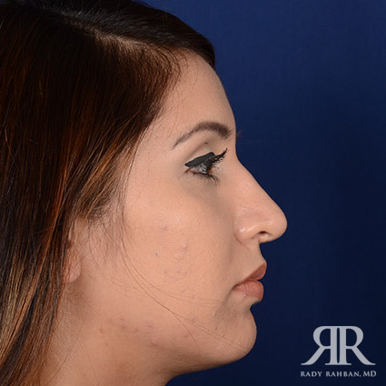 Female Rhinoplasty