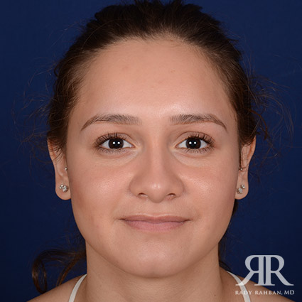 Female Rhinoplasty