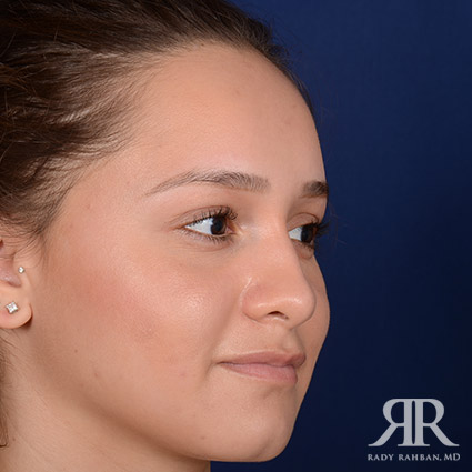 Female Rhinoplasty