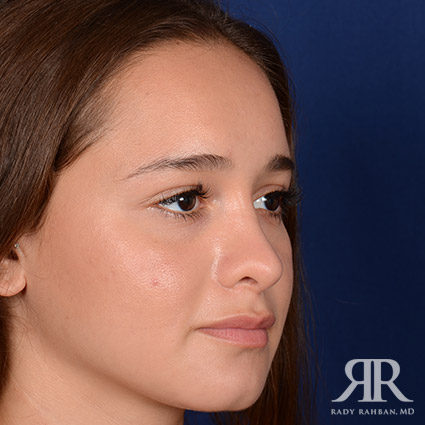 Female Rhinoplasty