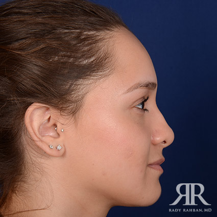 Female Rhinoplasty