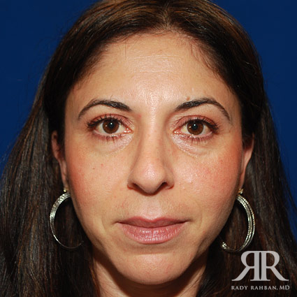 Female Rhinoplasty