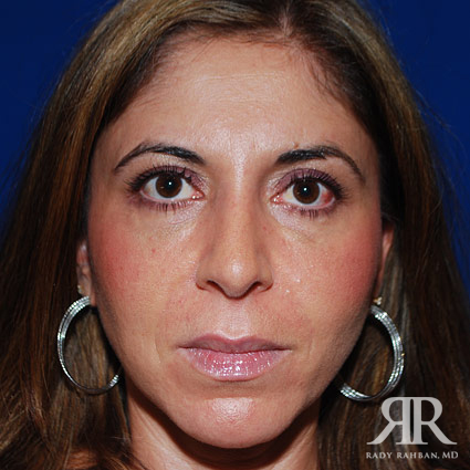 Female Rhinoplasty